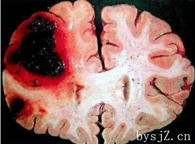 急性脑出血后心脏异常患者临床分析,正常人如何区分脑出血和心脏病，以及如何进行急救？