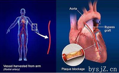 冠状动脉介入手术