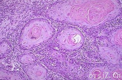 研究临床对乳腺癌病理应用组织学病理学与分子分类的临床诊断意义,你能告诉我乳腺癌的病理阶段是PTmicN0M吗？