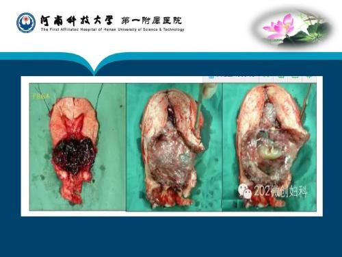 剖宫产子宫瘢痕部位妊娠中彩超的使用意义