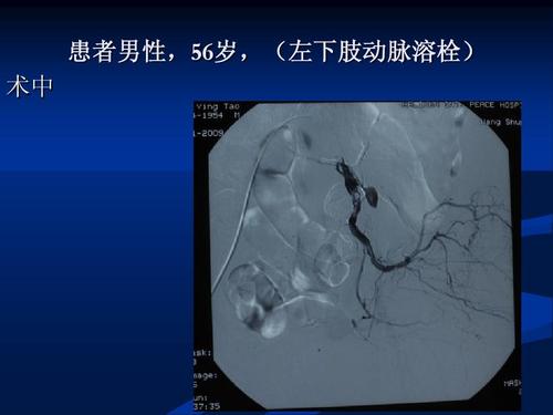 介入治疗下肢动脉硬化闭塞症的护理疗效观察