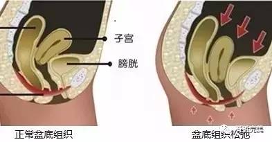 先天性阴道下段闭锁伴膀胱阴道瘘一例