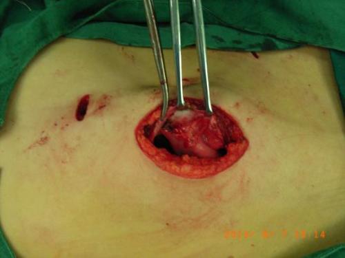 女性乳腺脓肿手术中微创切口的运用,乳房脓肿引流手术后伤口长时间未愈合。