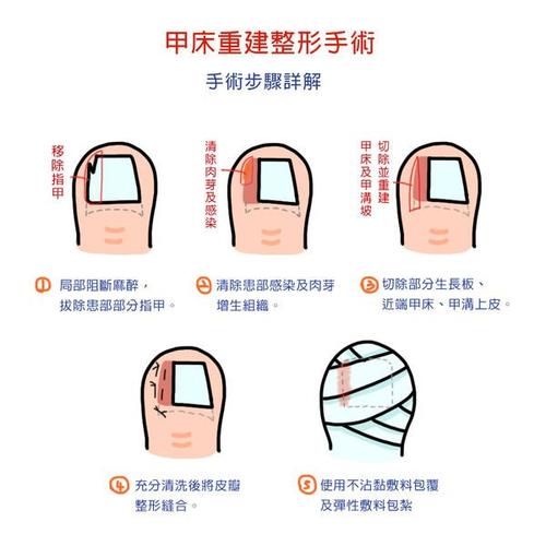 部分拔甲加甲床切除术治疗趾甲沟炎125例