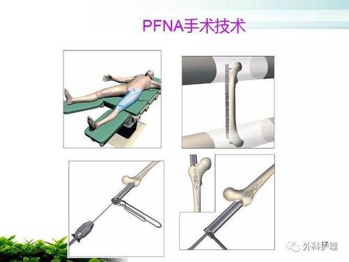 PFNA内固定术治疗股骨粗隆间骨折患者的护理配合