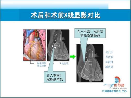 冠心病及PCI术后中西医结合研究进展