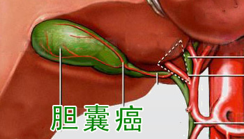 胆囊腺肌增生症与胆囊癌经超声诊断的效果观察