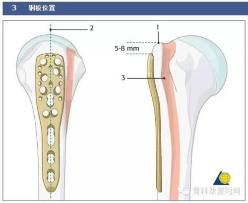 肱骨小头骨折患者运用肘关节外侧入路手术的疗效