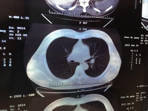 肺结节应用螺旋CT诊断的临床效果,我想做一次体检，特别是低剂量螺旋cT，这是主要的检查。...