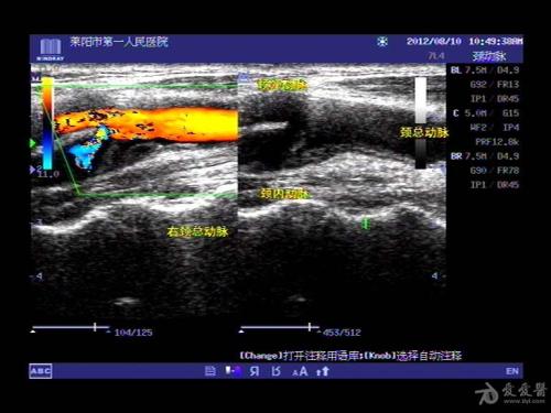 糖尿病患者颈动脉粥样硬化斑块诊断中彩超的应用效果