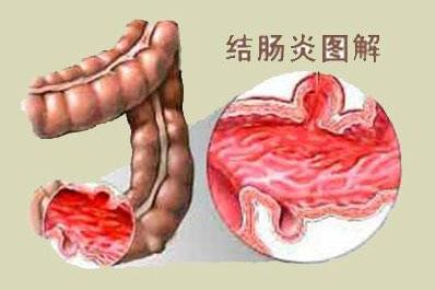 中药保留灌肠加西药治疗溃疡性结肠炎的疗效