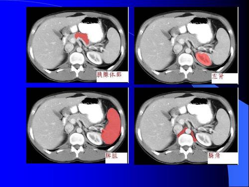 腹部闭合性损伤运用CT诊断的作用