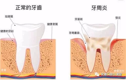 牙周炎患者正畸中牙周序列治疗的应用,牙周病，需要多长时间治疗？