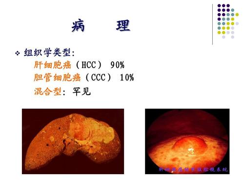 肝细胞癌和胆管细胞癌诊断中彩超的运用效果