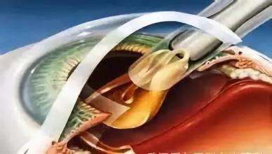 白内障患者施行小切口非超声乳化术的效果