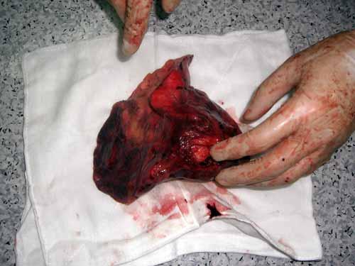 全肺切除术肺癌患者给予护理干预的效果观察