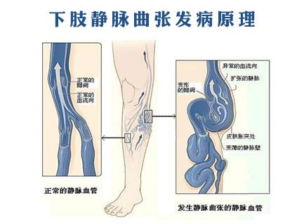 中医疗法对下肢静脉曲张术后及并发症的疗效探究,你了解下肢静脉曲张吗
