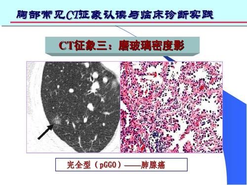 探讨肺混合磨玻璃结节腺癌的CT征象与病理的关系