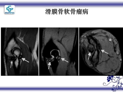 滑膜骨软骨瘤病的影像表现和手术病理分析