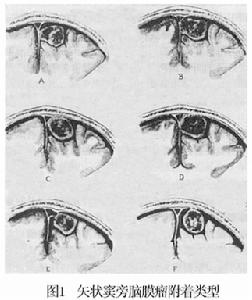 矢状窦旁脑膜瘤手术中临床护理路径的运用,大脑矢状窦旁区域的脑组织在哪里？