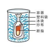 断指再造手术前的护理策略探究,手指再造后如何进行功能锻炼？