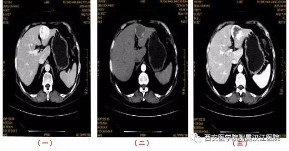 肝血管瘤CT平扫与CT增强的影像对比,肝脏增强ct如何鉴别肝癌和肝血管瘤