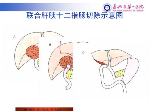 胰十二指肠切除术后癌症复发研究结果