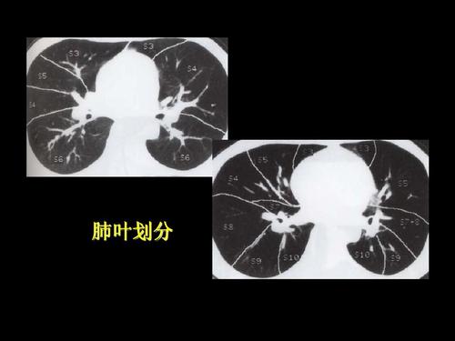 早期肺癌影像学诊断中螺旋CT的应用价值,做了螺旋CT后，医生说很可能是肺癌。你能做出明确的诊断吗