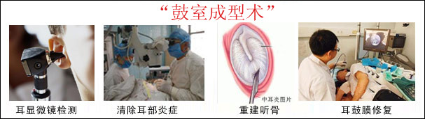 自体乳突骨皮质在开放式鼓室成形术中的应用,乳突根治术和鼓室成形术在正常情况下会降低听力吗