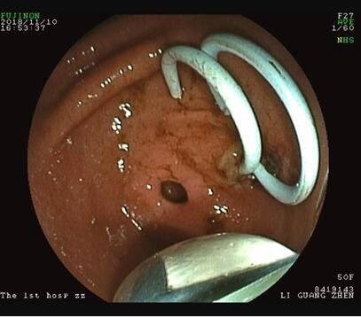 胰腺假性囊肿实施腹腔镜下经胃置管引流术的护理,胰腺假性囊肿的预后