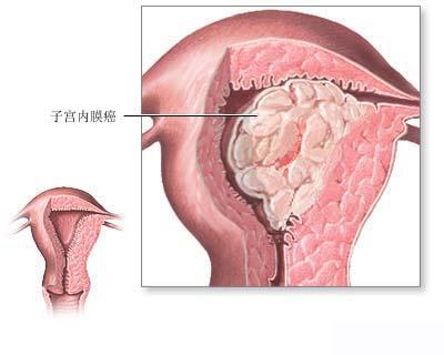 子宫腺癌样瘤临床症状与病理特点综述,什么是妇科恶性肿瘤？