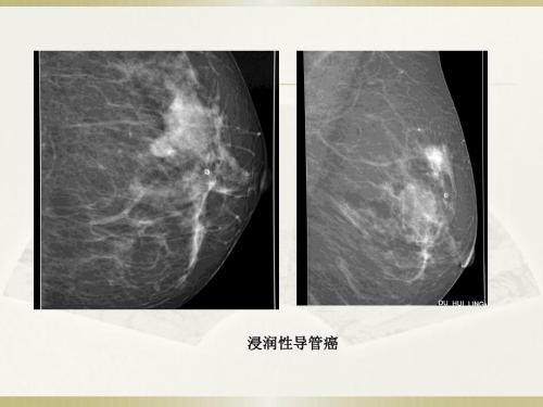 乳腺微小钙化患者应用乳腺钼靶检查的效果