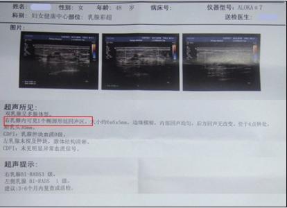 超声检查对于诊断乳腺硬化性腺病的作用,乳房硬化性腺症